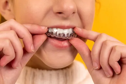 BSP Basic Periodontal Examination (BPE) & 2018 Guide